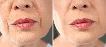 skin rejuvenation lips