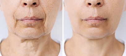 skin rejuvenation neck