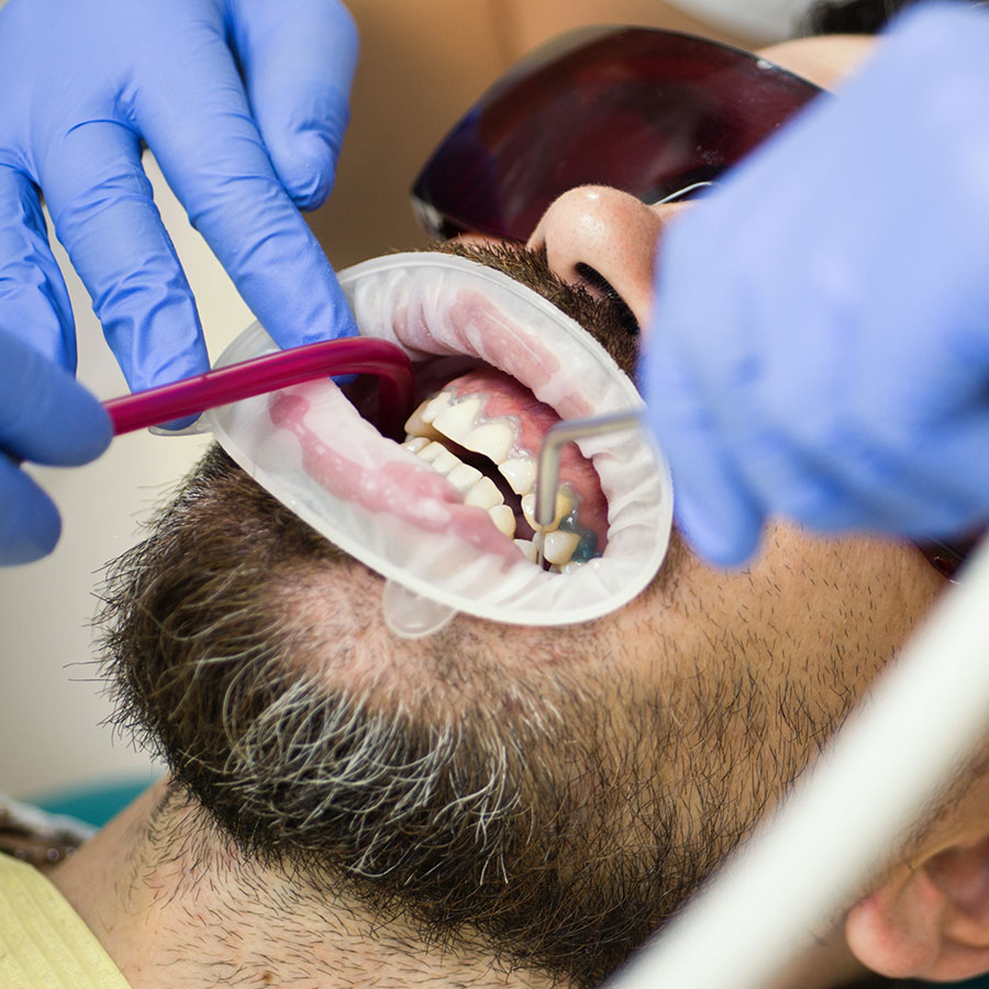 is teeth whitening safe image