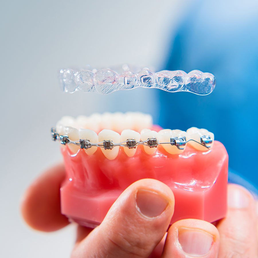 invisalign vs traditional braces image