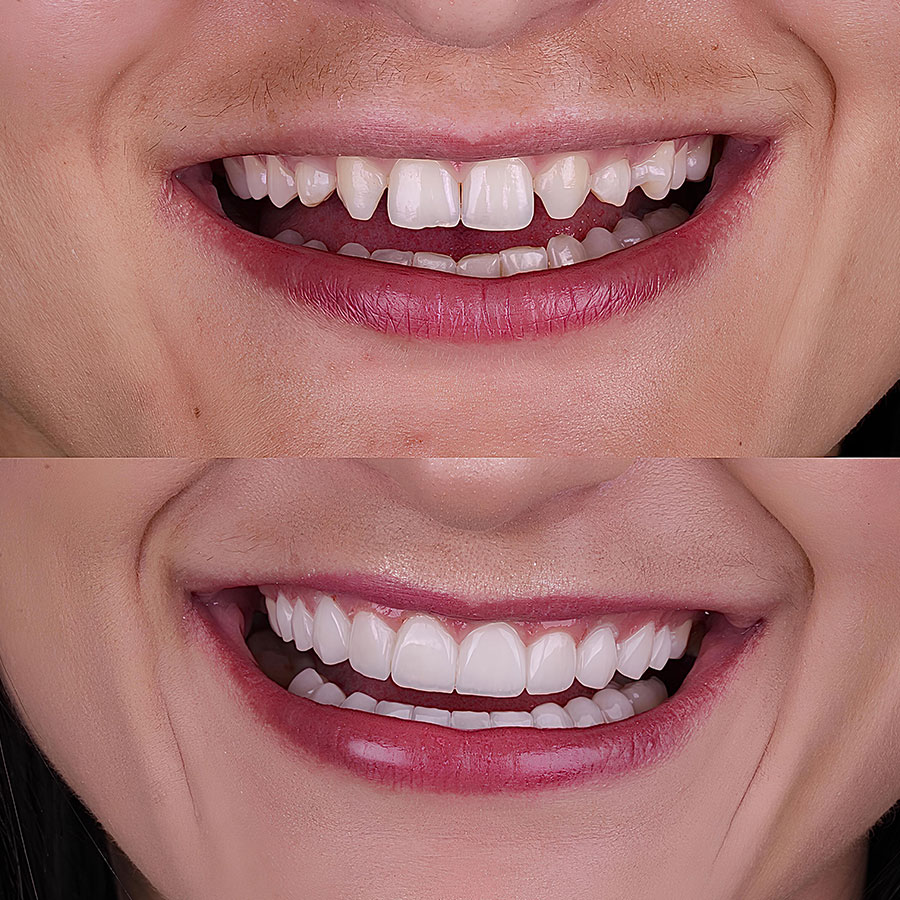 do dental veneers damage natural teeth image