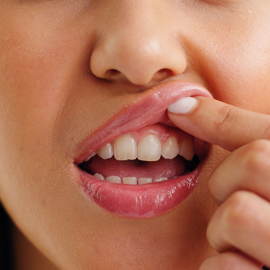 how many veneers do i need image