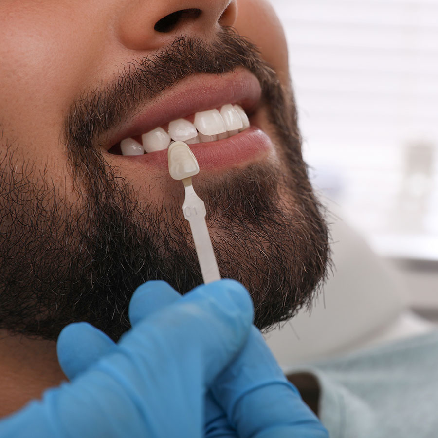 porcelain vs composite veneers image