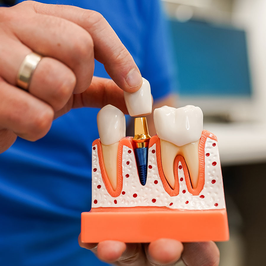 Dental implant consultation at Smile Creative studio in Ballarat Central